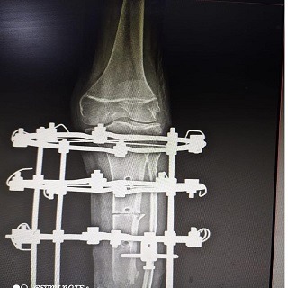 Best Complex Adult Trauma in Lucknow – Expert Care by Dr. Divyanshu Best complex adult trauma in Lucknow treated by Dr. Divyanshu Dutt Dwivedi with advanced orthopedic techniques.