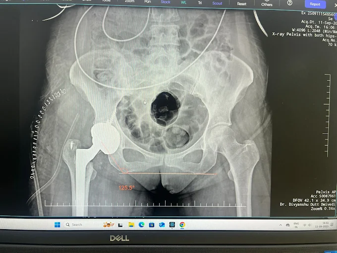 Experienced Hip Replacement Surgeon in Lucknow