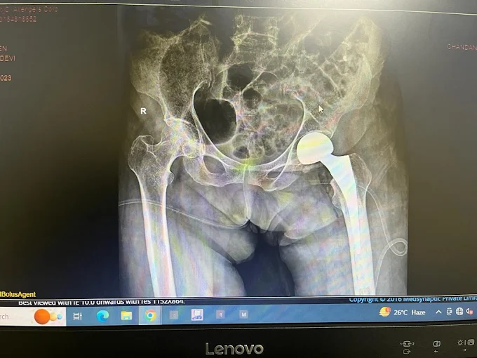 Trusted Hip Replacement in Lucknow
