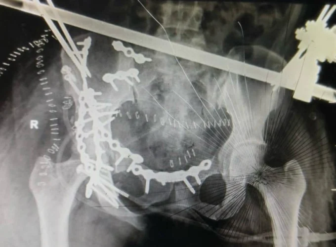 Advanced Hip Replacement Surgery in Lucknow