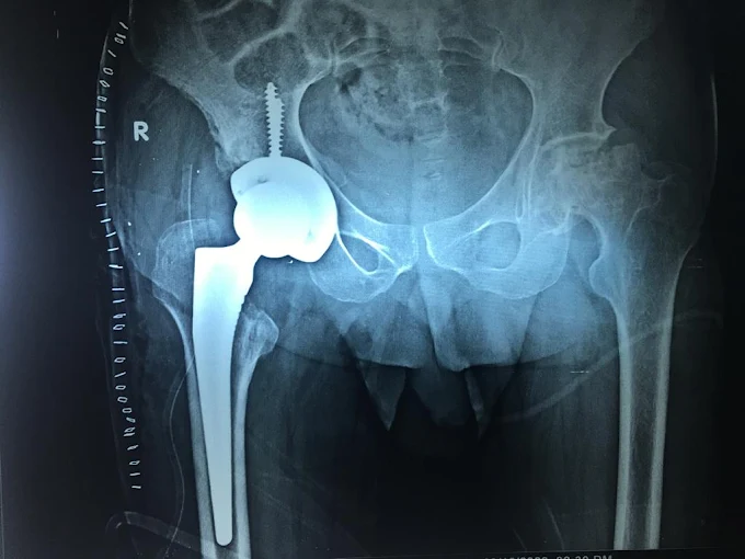 Best Hip Replacement Surgeon in Lucknow