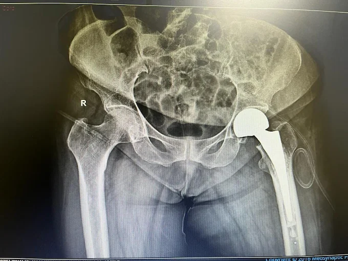 Best Hip Replacement Surgery in Lucknow
