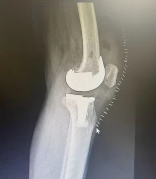 X ray showing successful knee replacement performed by the Best Knee Replacement Doctor in Lucknow.webp