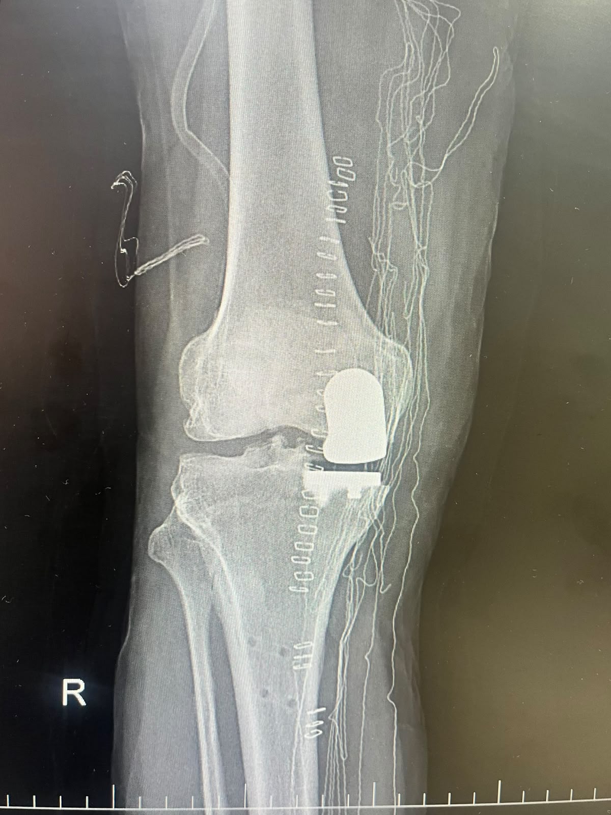 Robotic Knee Replacement in Lucknow